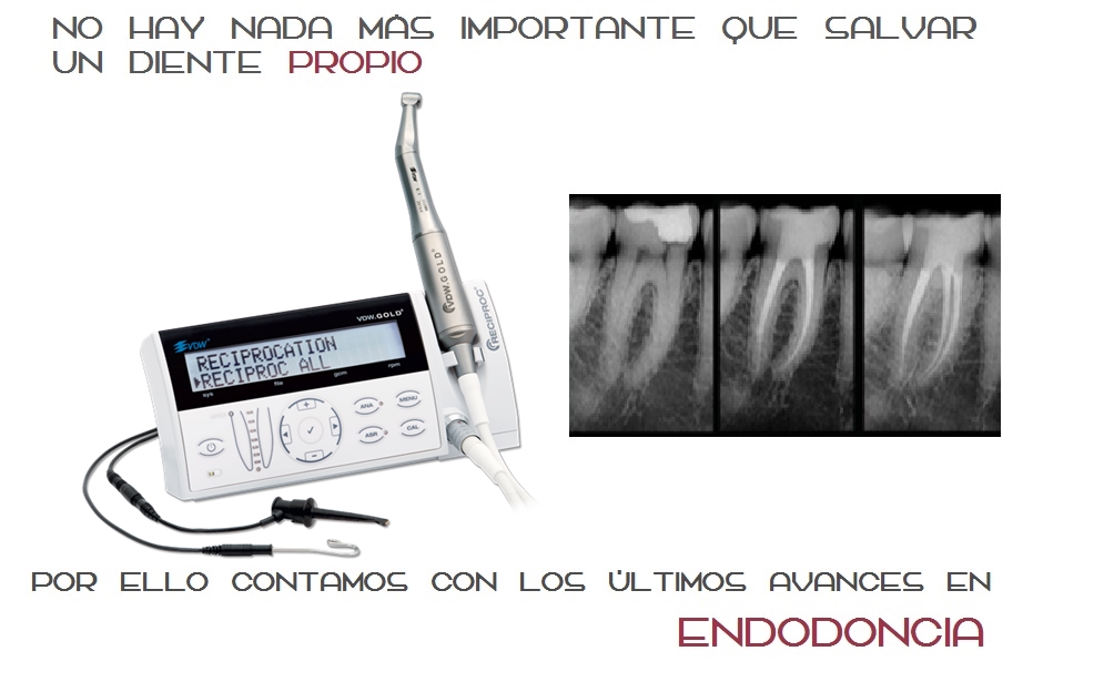 Tratamiento::Endodoncia